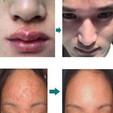 Effective Removal Acne Cream Spots Scar Stretch Marks Treatment Cream Skin Care