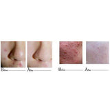 Effective Removal Acne Cream Spots Scar Stretch Marks Treatment Cream Skin Care