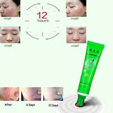 Effective Removal Acne Cream Spots Scar Stretch Marks Treatment Cream Skin Care