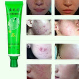 Effective Removal Acne Cream Spots Scar Stretch Marks Treatment Cream Skin Care