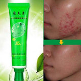 Effective Removal Acne Cream Spots Scar Stretch Marks Treatment Cream Skin Care